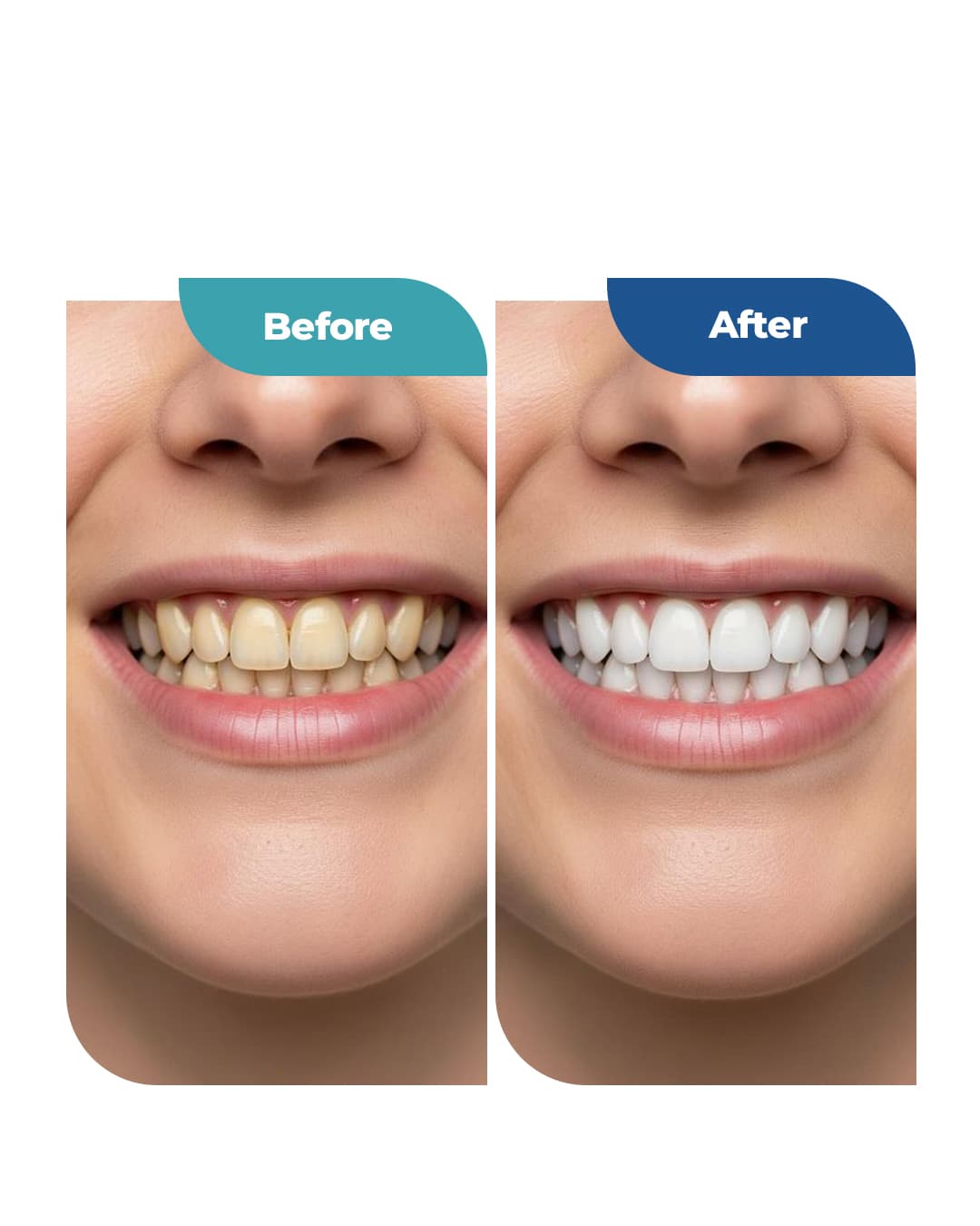 Teeth whitening result — before and after comparison